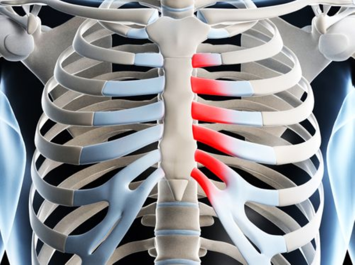 Cómo tratar el síndrome de Tietze con fisioterapia integrativa y fitoterapia