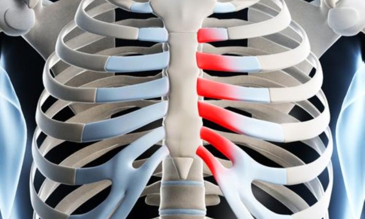 Cómo tratar el síndrome de Tietze con fisioterapia integrativa y fitoterapia