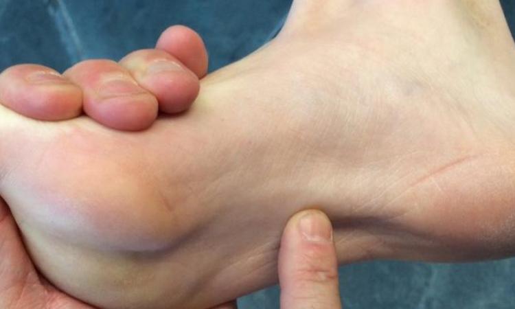 Fascitis plantar que no se cura: ¿estás tratando el síntoma o la causa real?